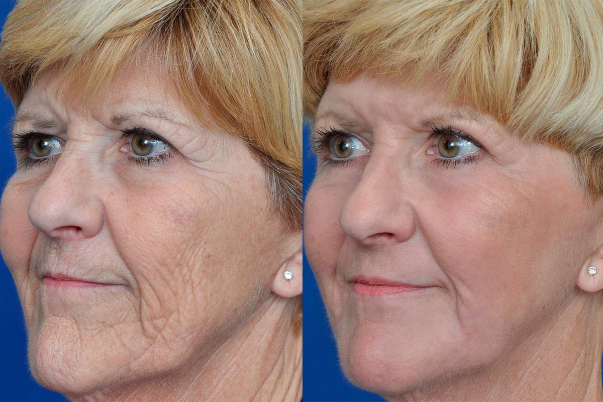 شد الوجه بالليزر